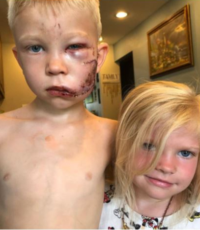 Un bambino di 6 anni ha salvato sua sorella dall’attacco di un cane